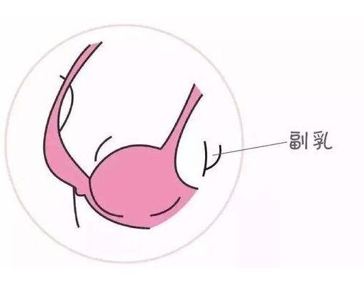 副乳切除術痛不痛？術前的注意事項？