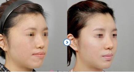 【科普】頜面外科整形包括哪些手術(shù)?