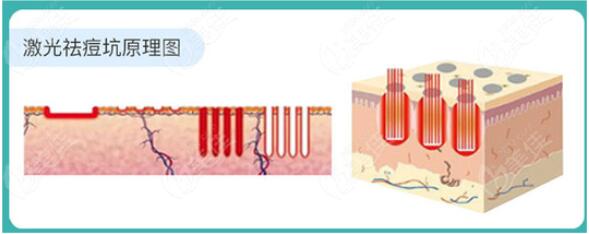 激光祛痘果好嗎?一般的價格是多少?
