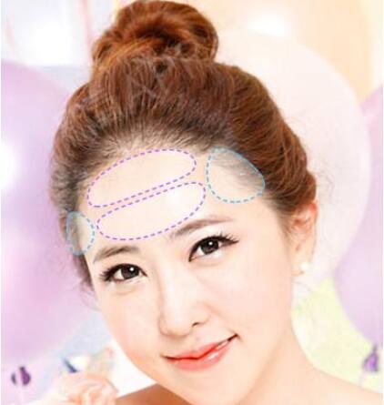 假體豐額頭的副作用有哪些?