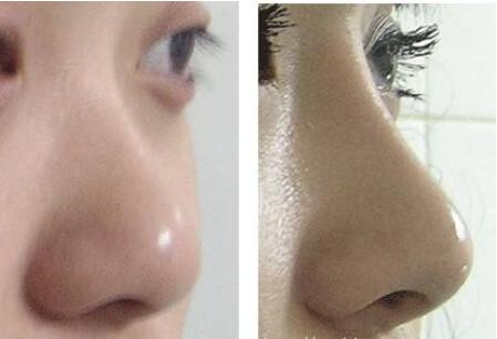 注射隆鼻后注意事項(xiàng)有哪些?