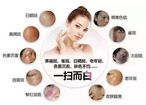 激光去斑的果怎么樣?會復發(fā)嗎?