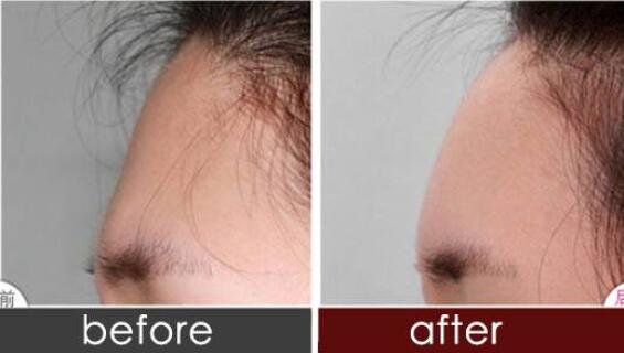 假體豐額頭里面有積液怎么辦啊!