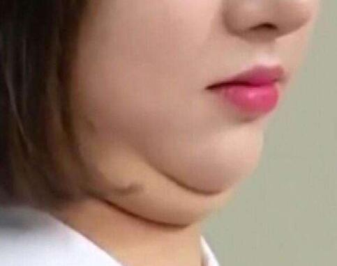 去掉厚重的雙下巴，可不止一種方法!