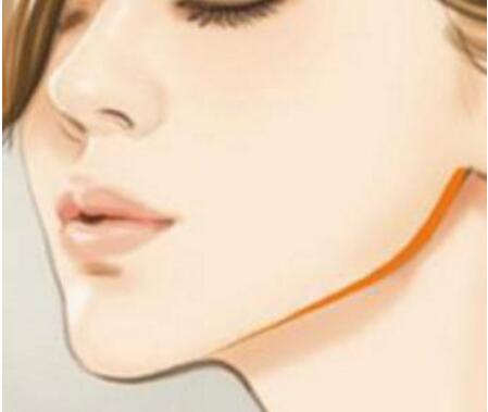 下頜角整形有幾種手術(shù)方式?術(shù)后護(hù)理過(guò)程需要注意什么?