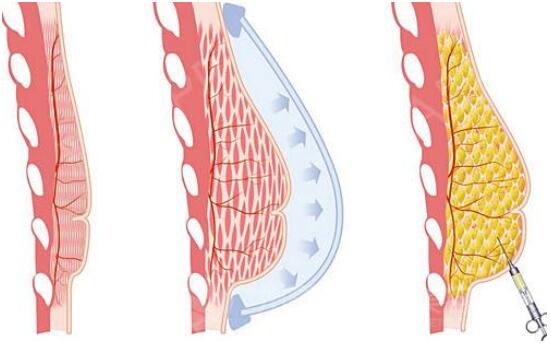 注射式隆胸好嗎?注射式隆胸后如何取出?