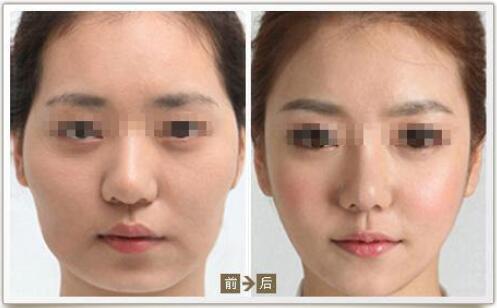 自體脂肪豐太陽穴手術(shù)前需要準備些什么?