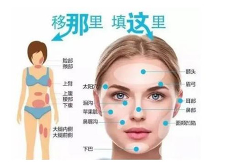 自體脂肪填充后時間久了會流失嗎