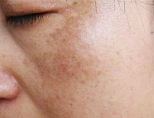 祛除黃褐斑一般要怎樣清除才徹底?