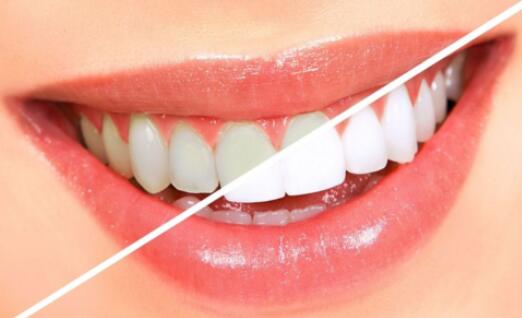 明星牙齒美白到底是怎么做的?怎么會(huì)那么白?