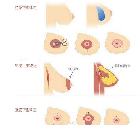 乳房下垂矯正多少錢(qián)_價(jià)格詳情及影響因素說(shuō)明
