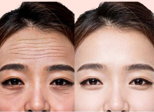 抬頭紋怎么祛除?有哪些小竅門嗎?