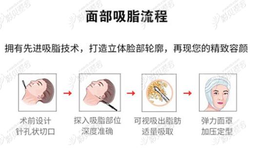 面部抽脂大概多少錢?是不是很貴?