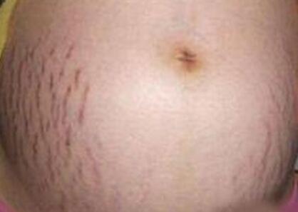 妊娠紋可以祛除嗎?要多少錢?