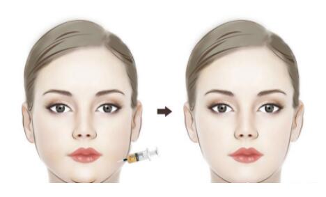 面部吸脂的價(jià)格是多少?果怎么樣?