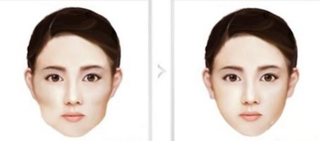 顴骨整形后應(yīng)該如何護理?感染了怎么辦?