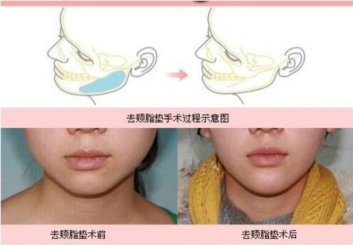 去頰脂墊果嗎?會不會反彈?