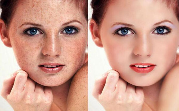 做化學剝脫去黃褐斑禁忌人群及適宜人群有哪些?