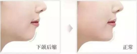 上頜后縮如何矯正?手術(shù)有風險嗎?