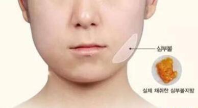 去頰脂墊價格貴不貴?收費(fèi)情況說明