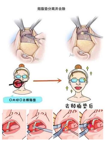 去頰脂墊果怎么樣?嗎?