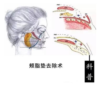 去頰脂墊有副作用嗎?術(shù)后如何護(hù)理可以減小副作用?