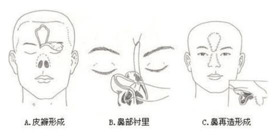 全鼻再造術找誰做?國內哪些醫(yī)生做得好?