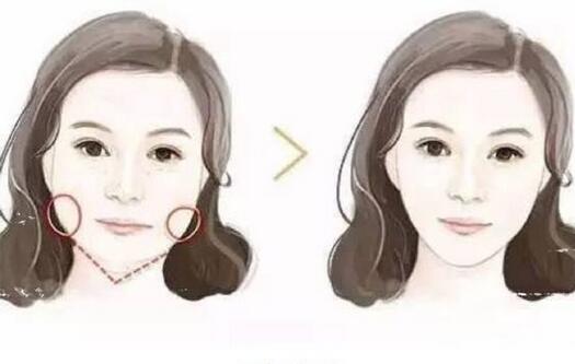 去頰脂墊后遺癥的常見情況有哪些?