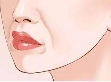 去鼻唇溝多少錢?哪種材料便宜些?