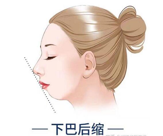 后縮下顎角的整形會(huì)起到多大的改變作用？