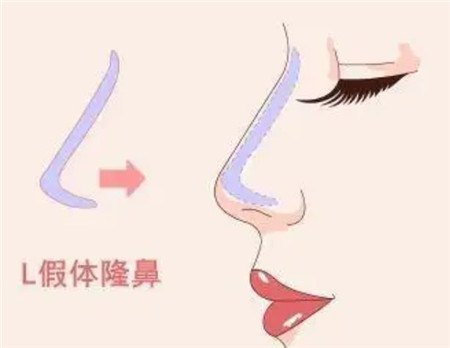 矯正朝天鼻效果如何，注意事項有哪些