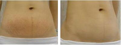 做腹壁整形去妊娠紋調(diào)節(jié)果怎么樣?果保持時間多久?