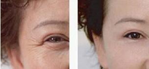 做脈沖光去眼角細(xì)紋調(diào)節(jié)果怎么樣?果保持時(shí)間多久?