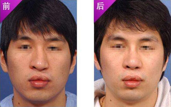 做歪鼻矯正調(diào)節(jié)果怎么樣?果保持時(shí)間多久?