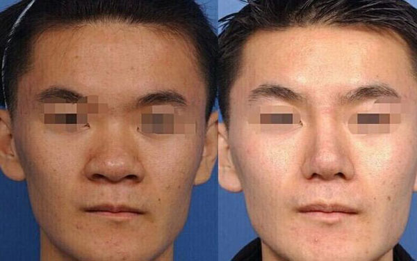 做蒜頭鼻調(diào)節(jié)調(diào)節(jié)果怎么樣?果保持時間多久?