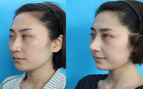 做鼻中隔軟骨墊鼻尖調節(jié)果怎么樣?果保持時間多久?