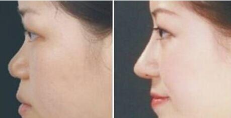 做微晶瓷隆鼻調(diào)節(jié)果怎么樣?果保持時(shí)間多久?