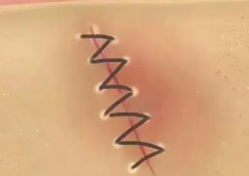 有哪些疤痕修復(fù)的方法