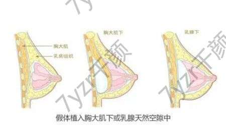 假體隆胸有哪些缺點(diǎn)和危害
