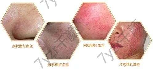 用激光清除紅血絲是不是的呢？注意事項(xiàng)有哪些?