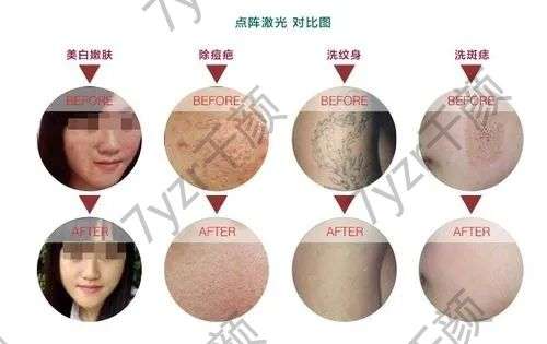 激光祛痘的原理是什么，有哪些需要注意？