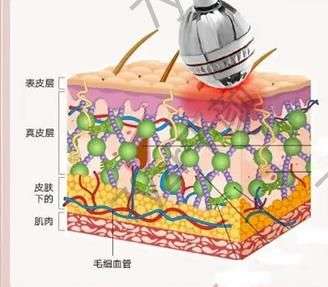 射頻緊膚除皺有哪些優(yōu)勢，要多少錢?