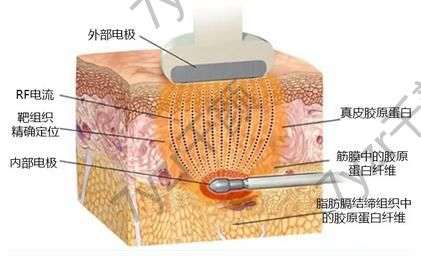 射頻緊膚有什么副作用