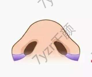 鼻翼縮小有什么風(fēng)險，會影響呼吸嗎