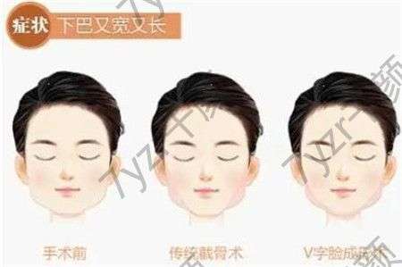 有哪些好的豐下巴方法?