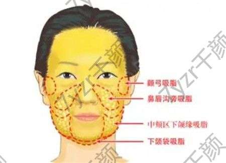 面部吸脂有沒有危險(xiǎn)，有哪些危害