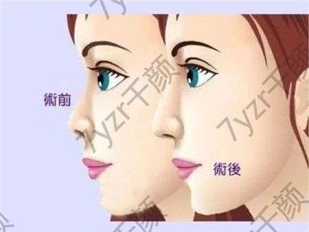 假體隆鼻的效果可以永久存在嗎?