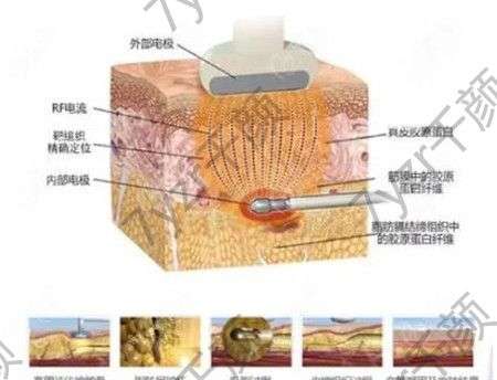 眼皮吸脂是怎么抽的，步驟是怎么樣的
