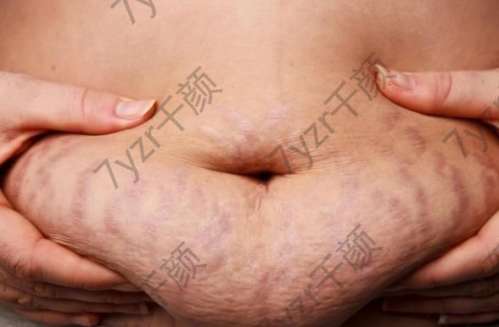 皮膚瘢痕小科普，祛疤方案知幾何？