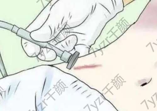 生姜片涂抹能祛疤？專家提醒：這些“民間處方”莫信